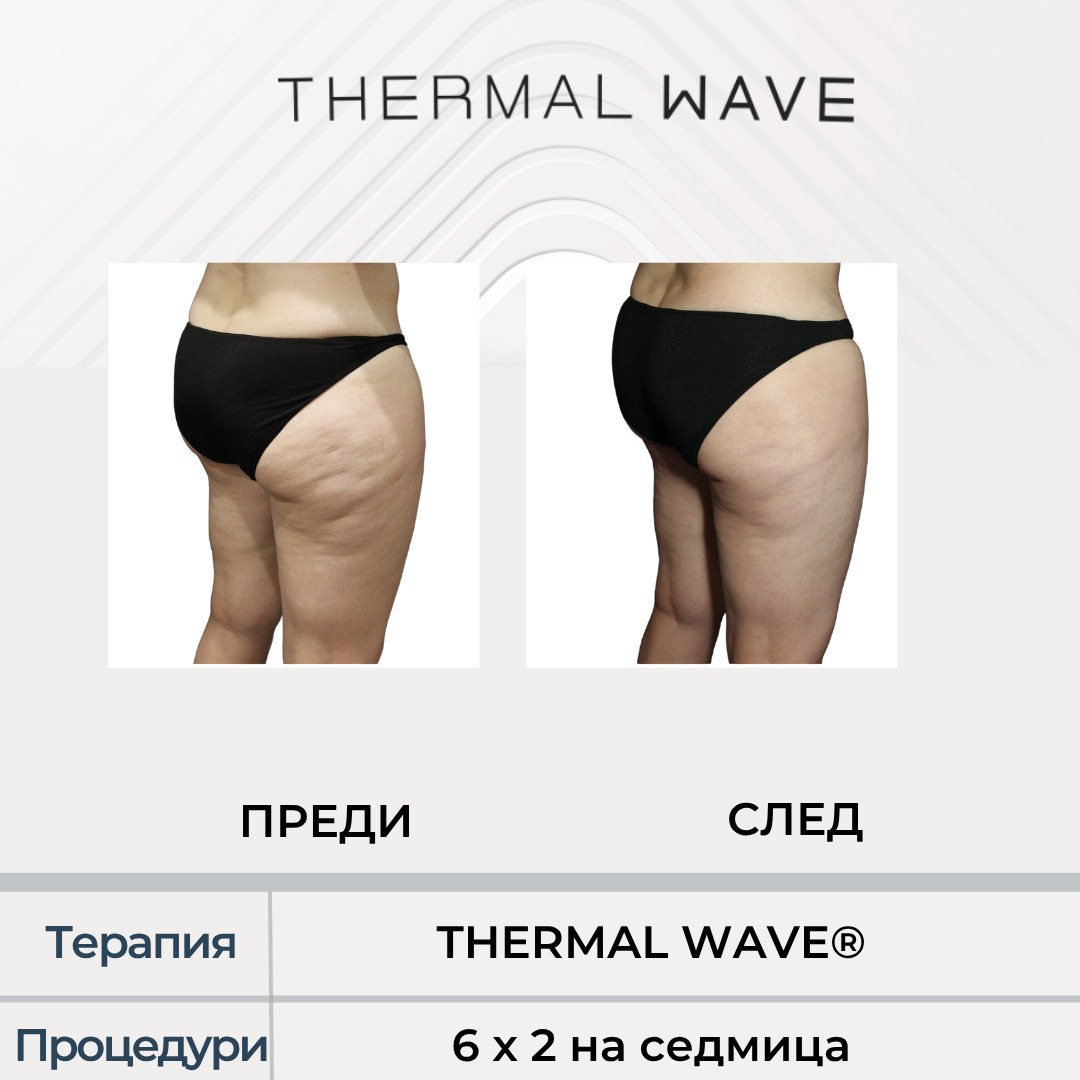 Бедра преди и след THERMAL WAVE