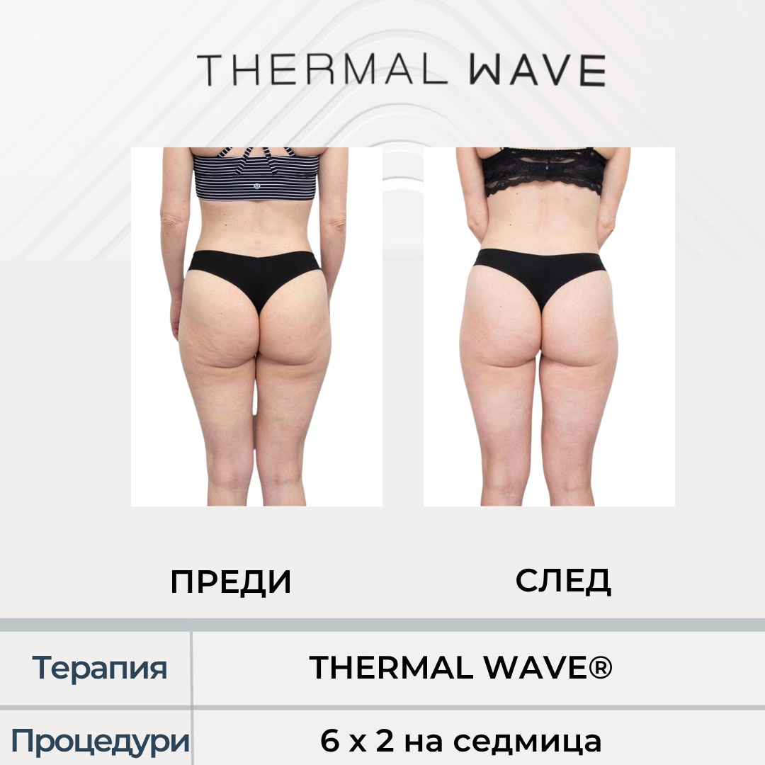 Седалище и бедра преди и след THERMAL WAVE
